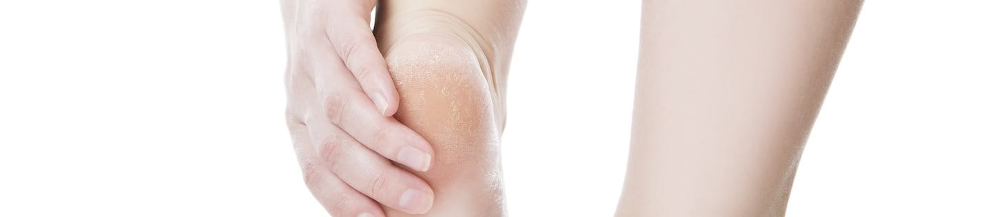 Füße einer Frau mit angehobener linker Ferse, auf der Hornhaut zu sehen ist