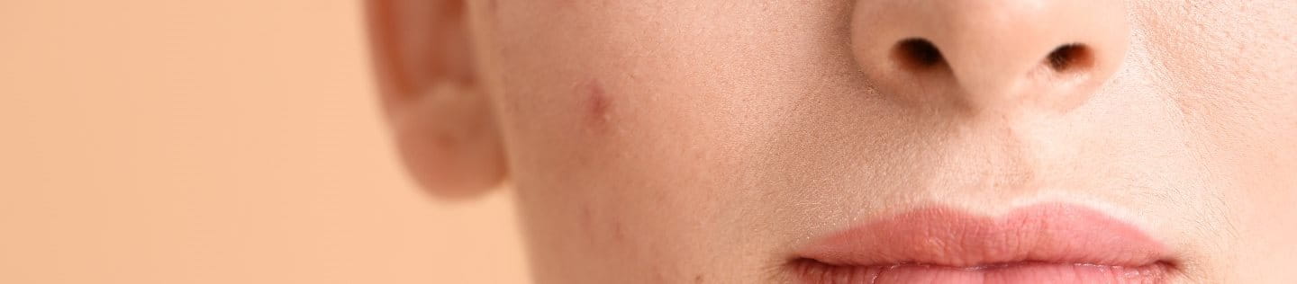 Nahaufnahme einer Frau mit entzündete, Pickel im Gesicht.