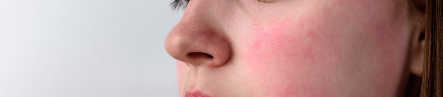 Frau mit Gesichtsrötungen