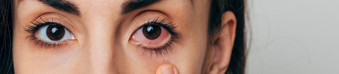 Frau mit gerötetem Auge