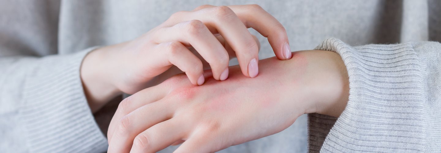 Hände mit Neurodermitis im Winter-Pullover