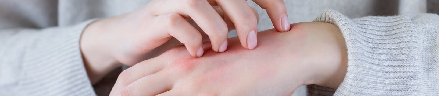 Hände mit Neurodermitis im Winter-Pullover