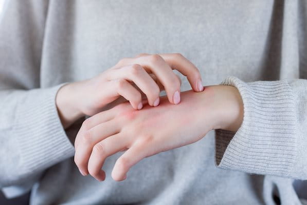 Hände mit Neurodermitis im Winter-Pullover