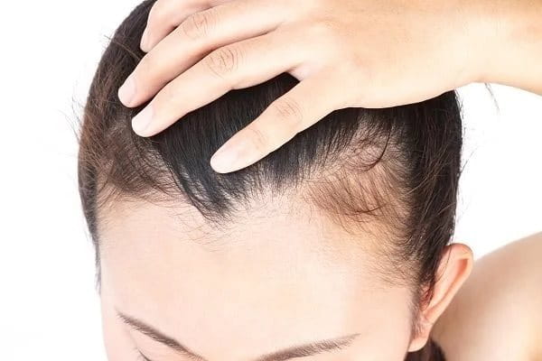 Frau hält mit einer Hand ihren Haaransatz zurück, sodass Stellen mit weniger Haaren zu sehen sind