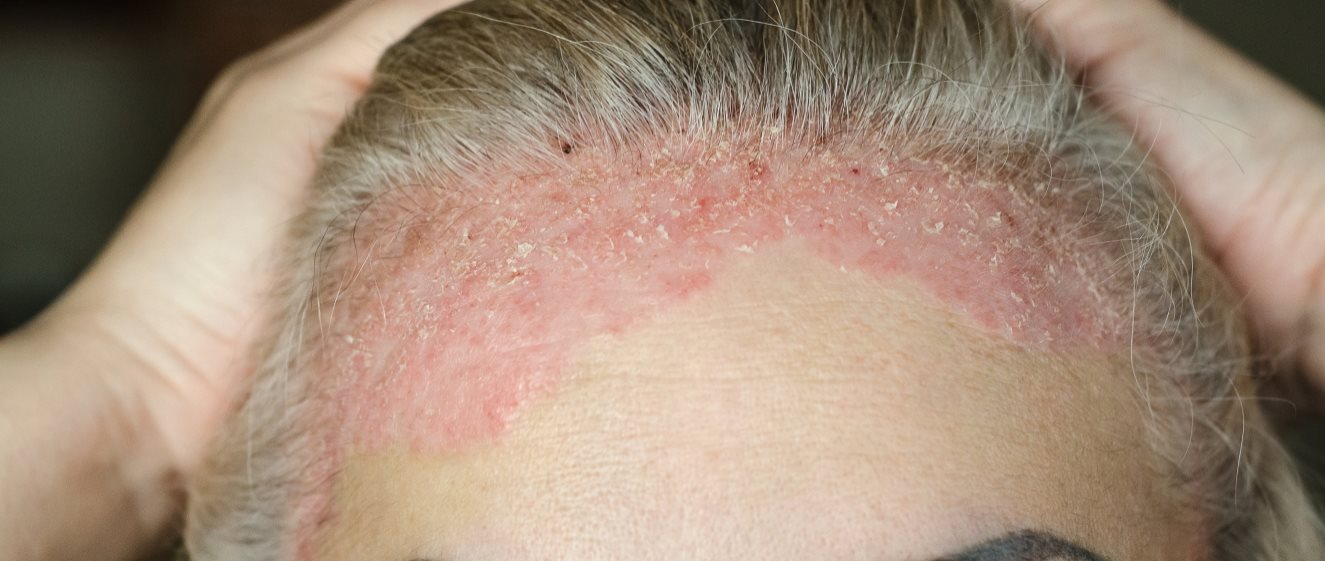 Schuppenflechte auf der Kopfhaut