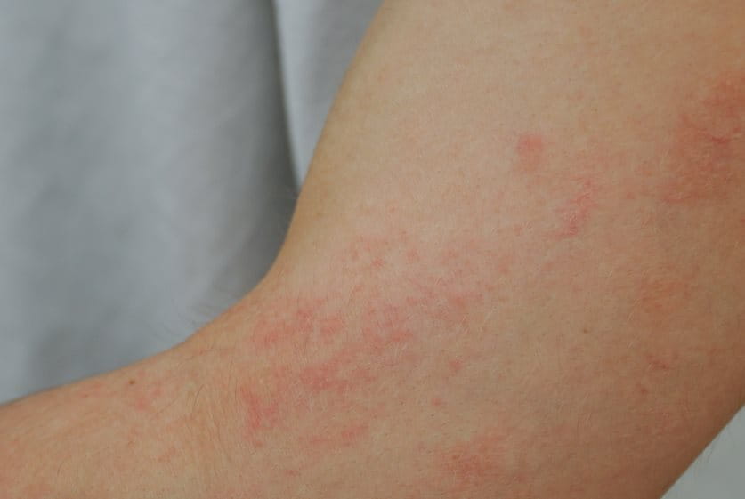 Rote Flecken auf der Haut am Arm