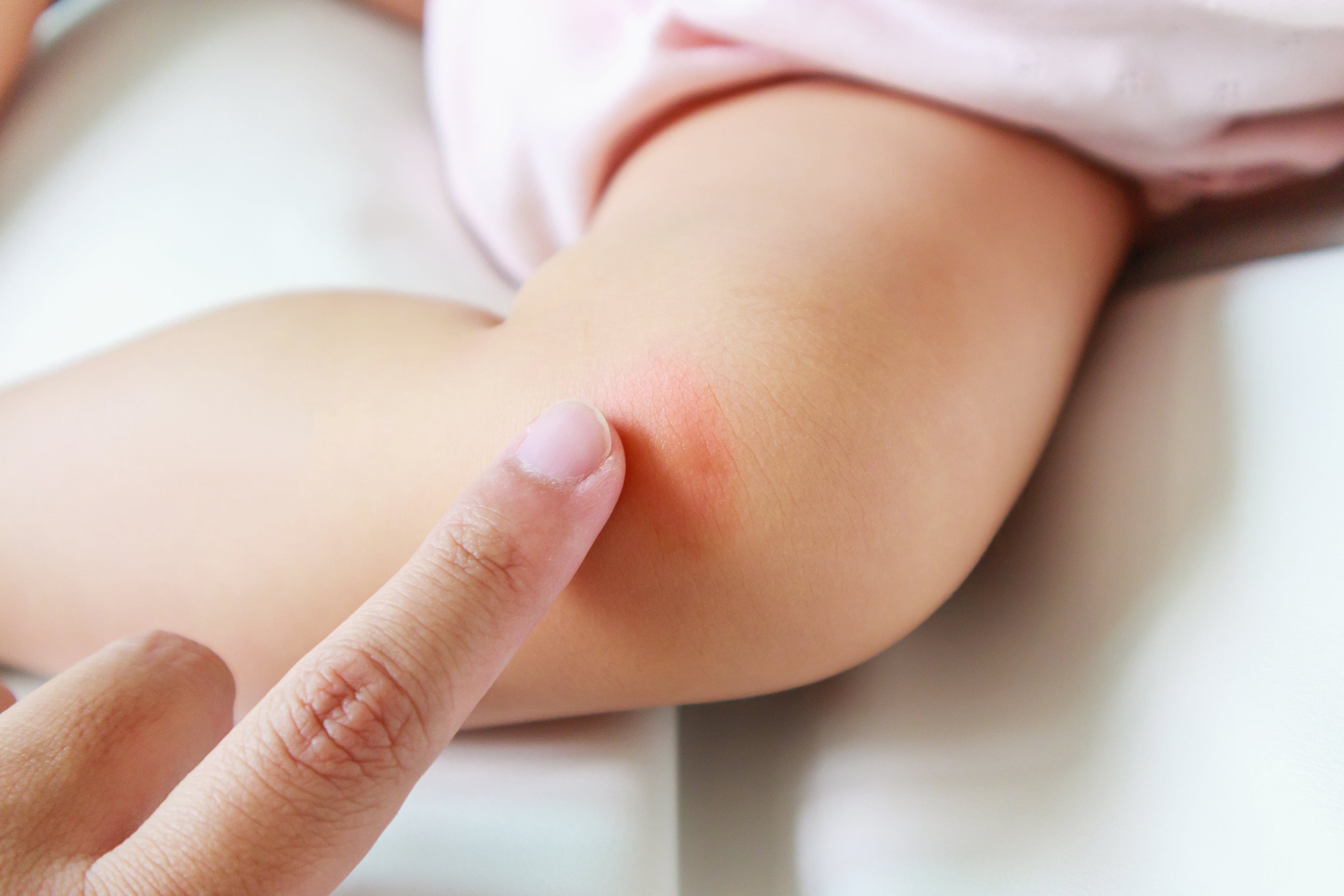 Gerötete Haut am Knie eines Babys wird mit einem Finger berührt