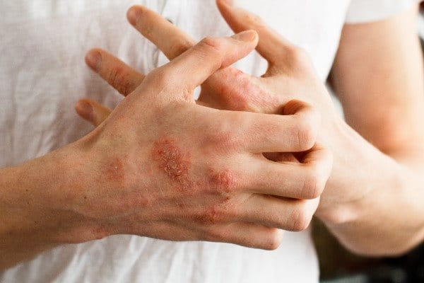 Hautirritationen durch Ekzeme an den Händen