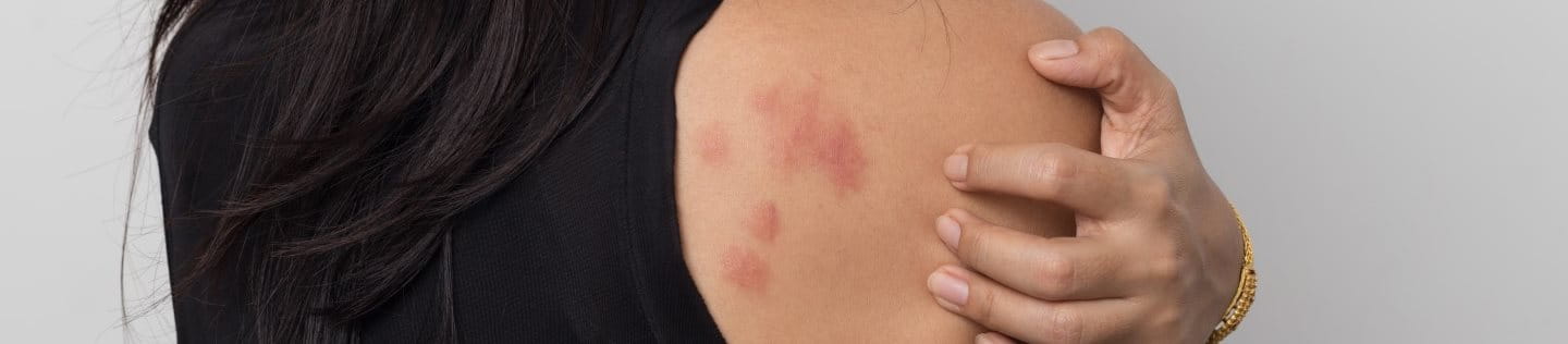 Eine Frau von hinten mit Nesselsucht an der Schulter.