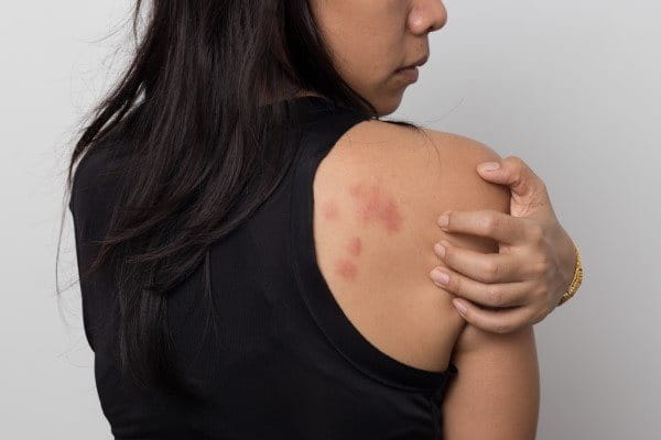 Schulterblatt einer Frau mit Hautrötungen