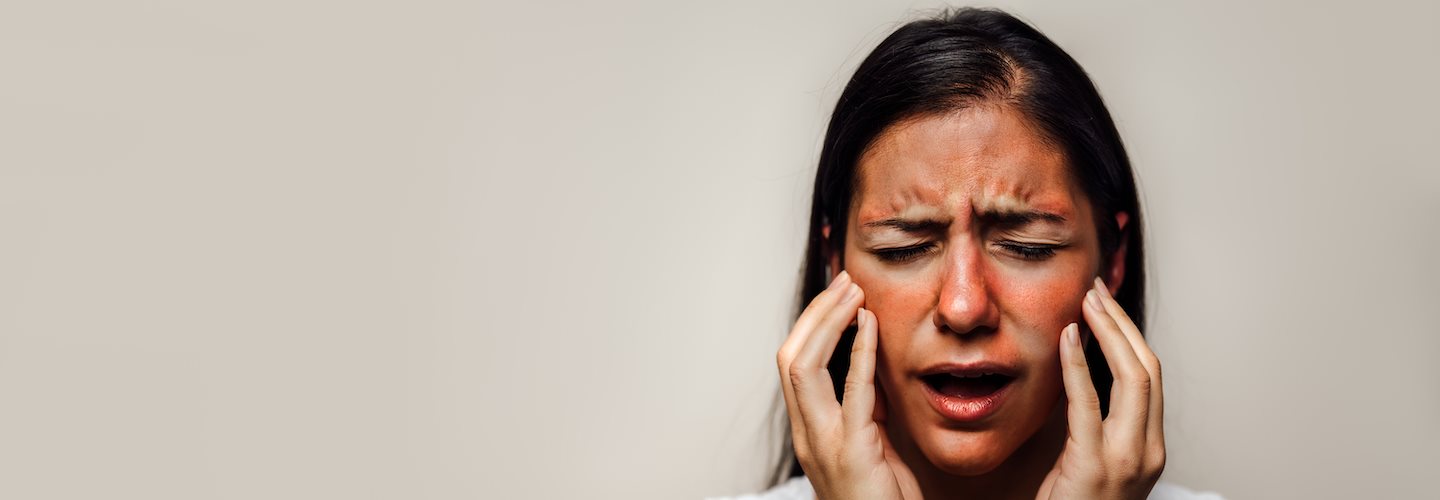 Gesicht einer Frau mit roter Haut durch eine phototoxische Reaktion