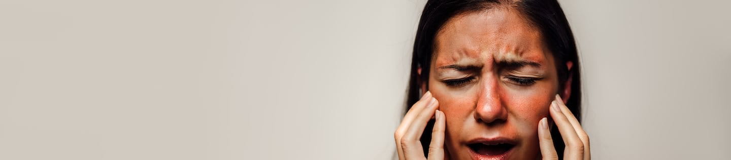 Gesicht einer Frau mit roter Haut durch eine phototoxische Reaktion