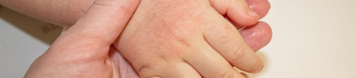 Sonnenallergie auf der Hand eines Kindes
