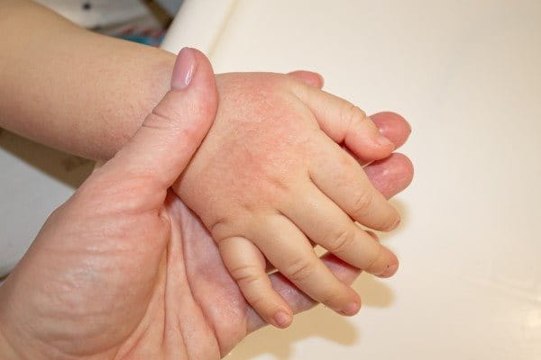 Sonnenallergie auf der Hand eines Kindes