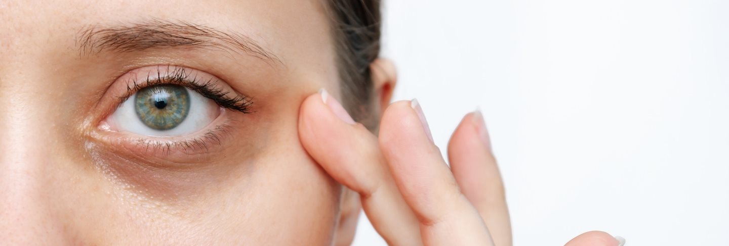 Dunkle Augenringe entstehen oft als Begleiterscheinung von Schlafmangel, Stress oder Erkrankungen. Erfahre hier, was du gegen Augenringe tun kannst. 
