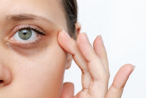 Eine junge kaukasische Frau fasst sich neben ihr Auge mit dunklen Augenringen an die Schläfe