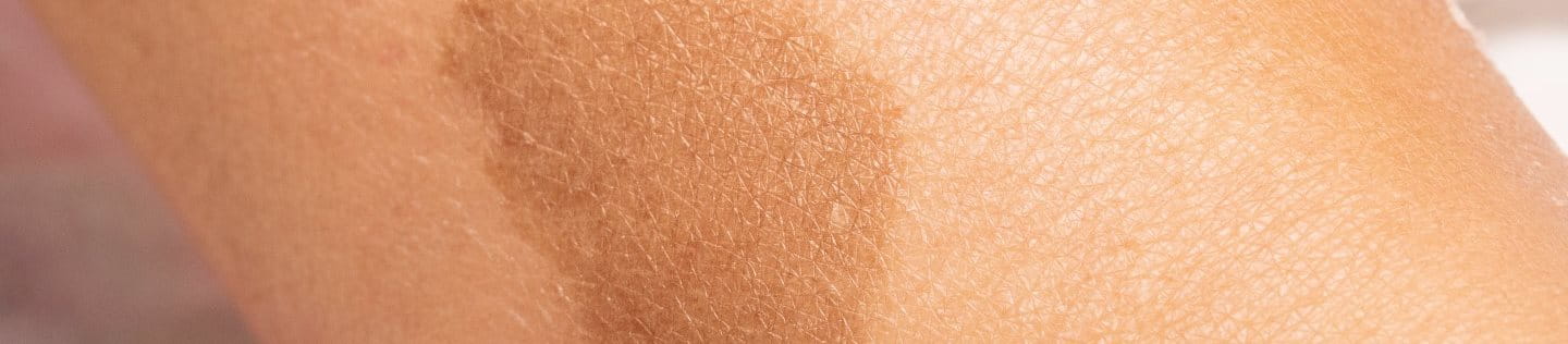 Café-au-lait-Fleck am Arm