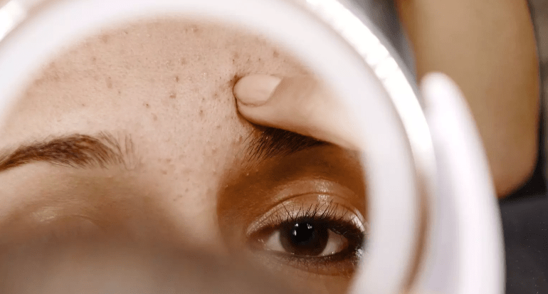 Acné - Quels sont les différents types d'acné et comment y ...