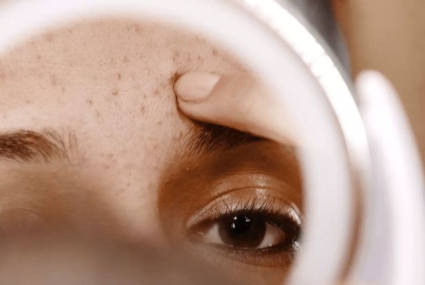 Quels sont les différents types d’acné ?