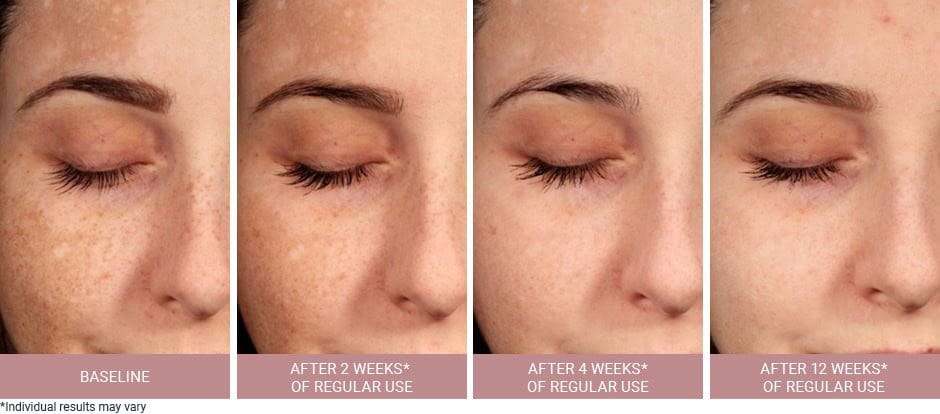 images of hyperpigmentation before and after being treated with Eucerin Anti Pigment products