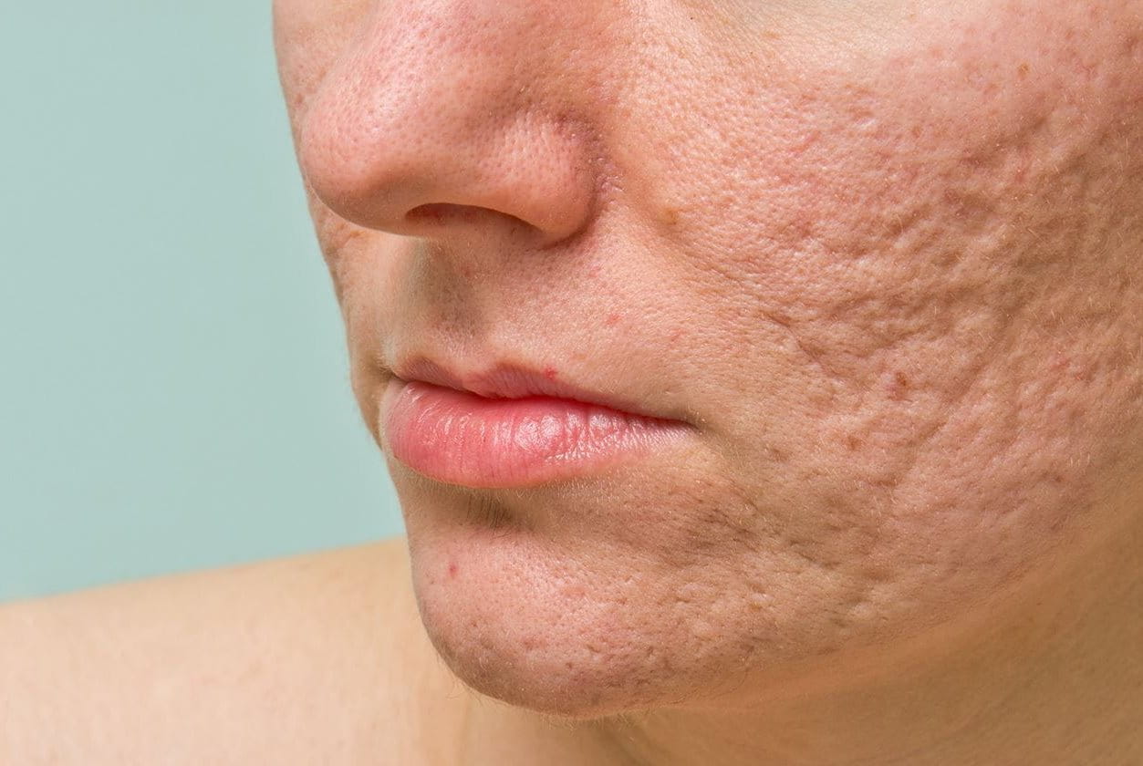 Acne scars on face