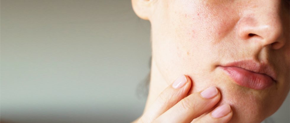 Dealing with acne mark