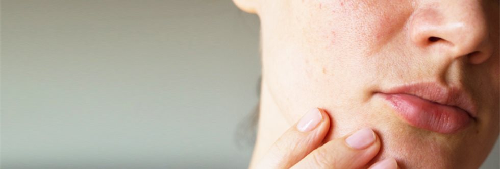 Dealing with acne mark