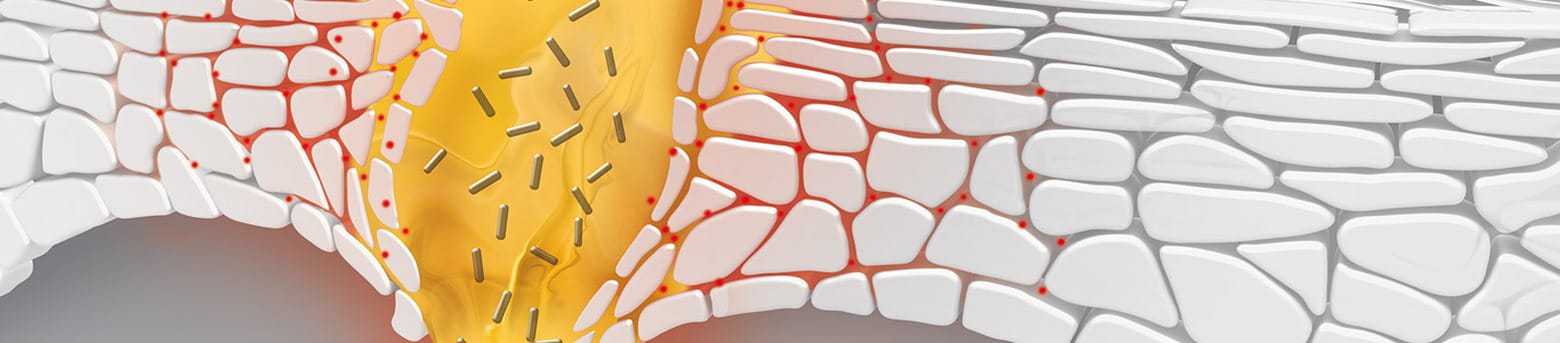 Čo spôsobuje nedokonalosti pleti