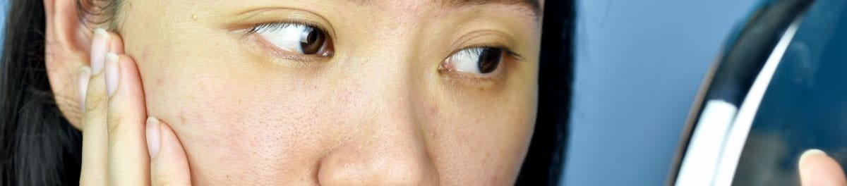 ผิวหน้าติดสารสเตียรอยด์