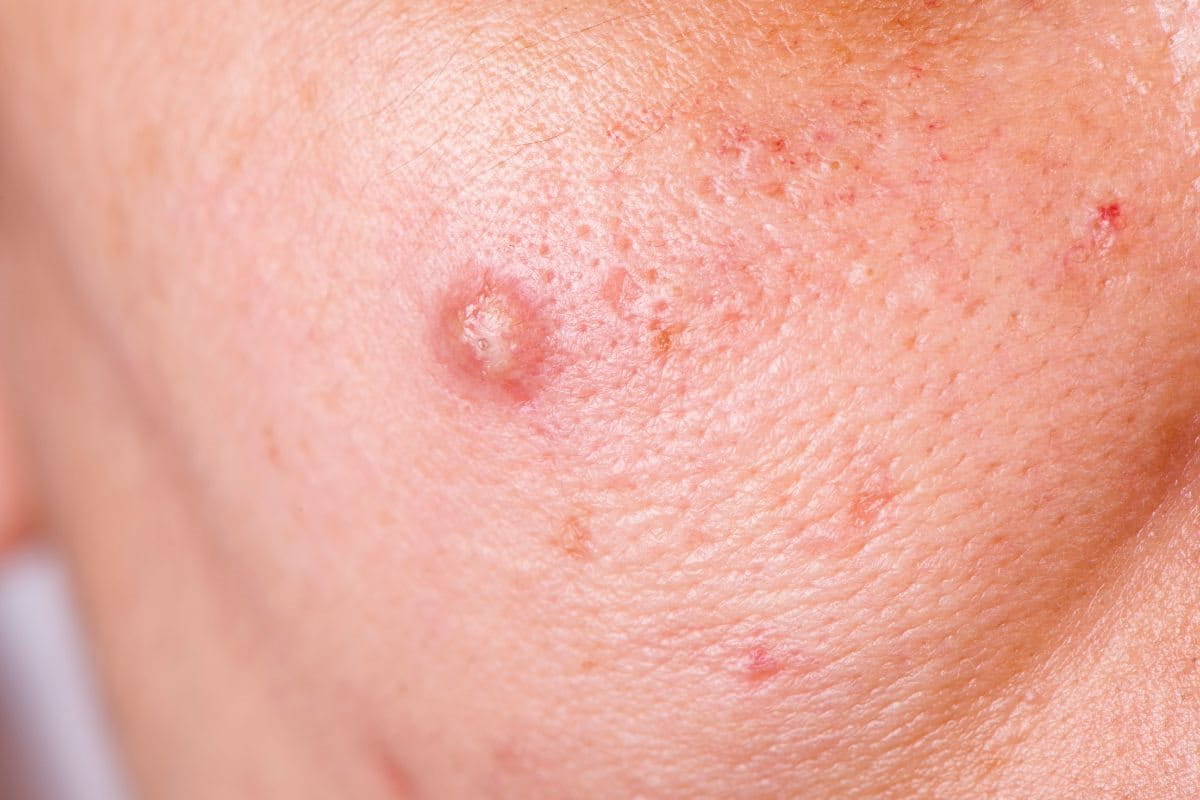 สิว ซีสต์