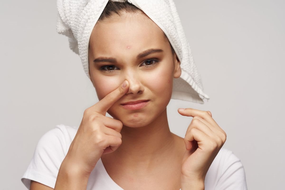 สิวในจมูก