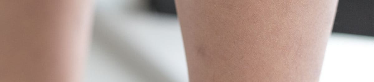 น้ำเหลืองไม่ดี