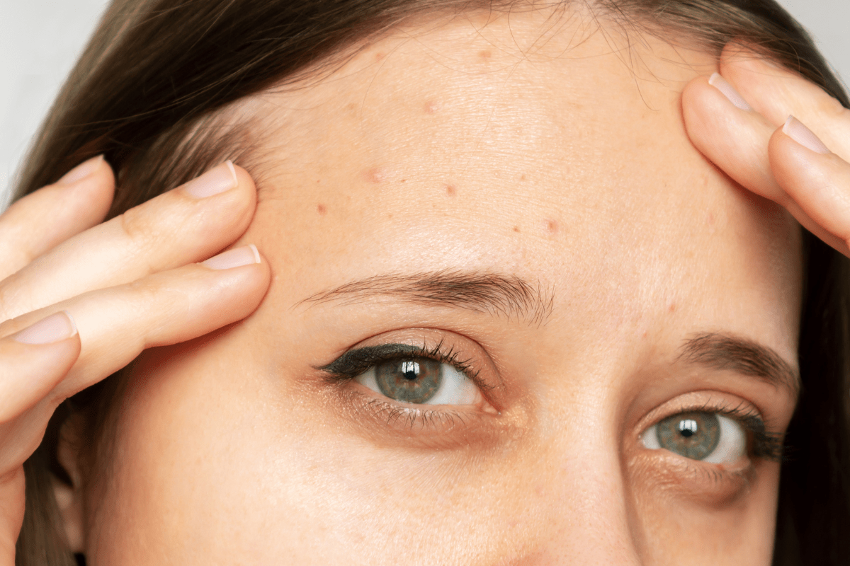 สิวผดที่หน้าผาก 