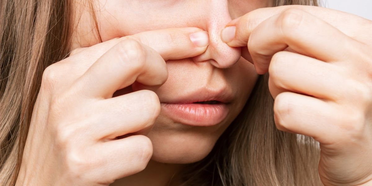 สิวขึ้นจมูก,สิวที่จมูก,สิวในจมูก