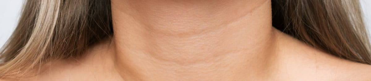 คอเป็นเส้น