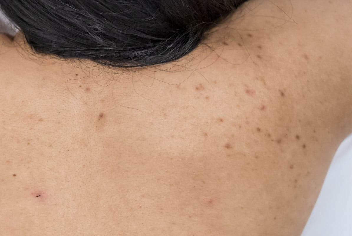 รอยสิวที่หลัง