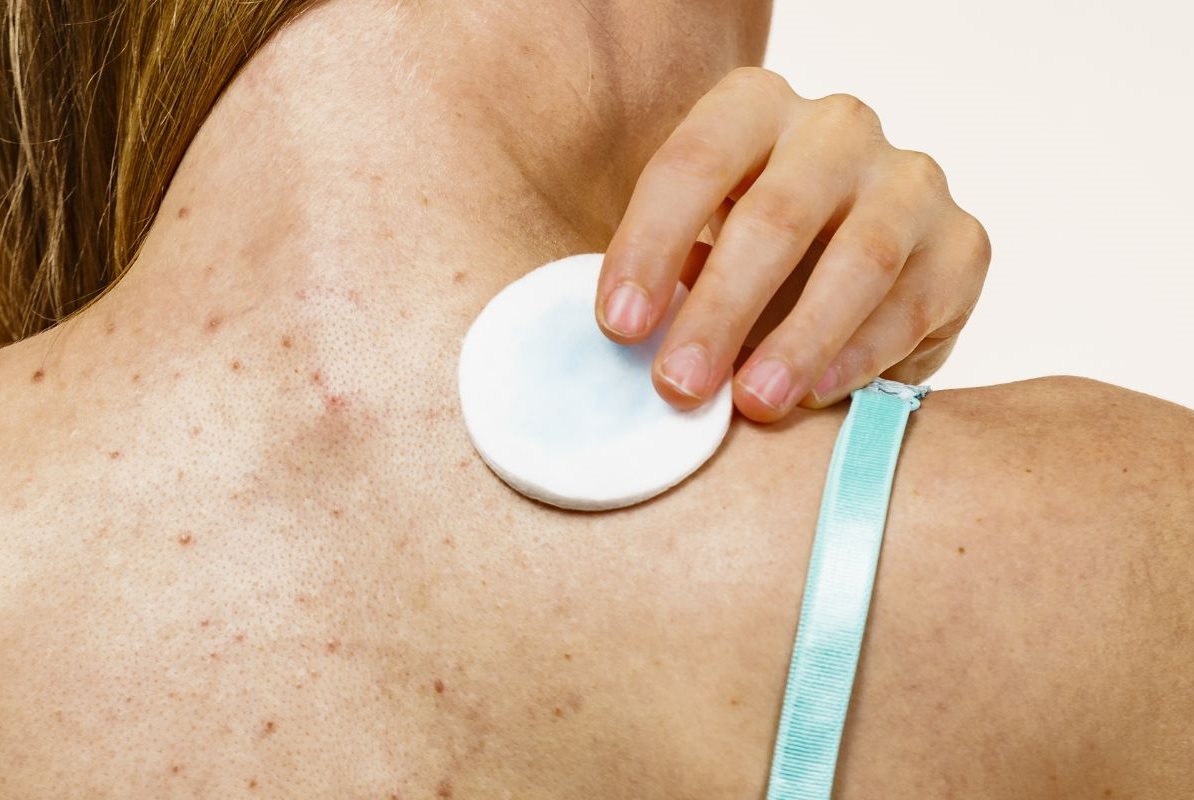 เป็น สิว ที่ หลัง ใช้ อะไร หาย