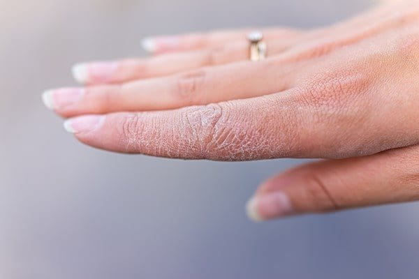 Hand of a woman with dry skin.