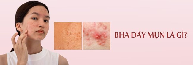 BHA đẩy mụn