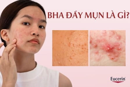 BHA đẩy mụn