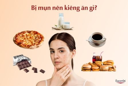 Bị mụn nên kiêng ăn gì? Chế độ ăn hợp lý cho người bị mụn