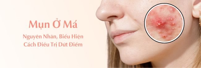 bị mụn ở má