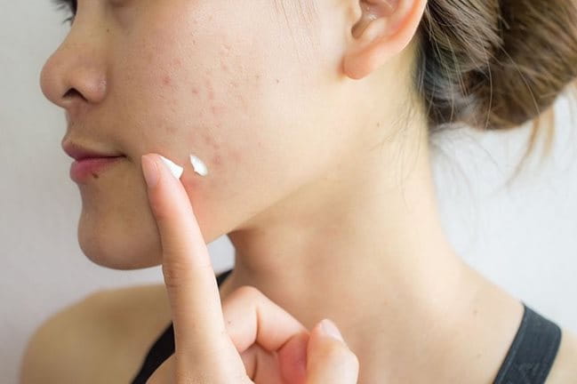 Các sản phẩm chấm mụn có công dụng hữu hiệu trong việc triệt tiêu các nốt mụn vi điểm