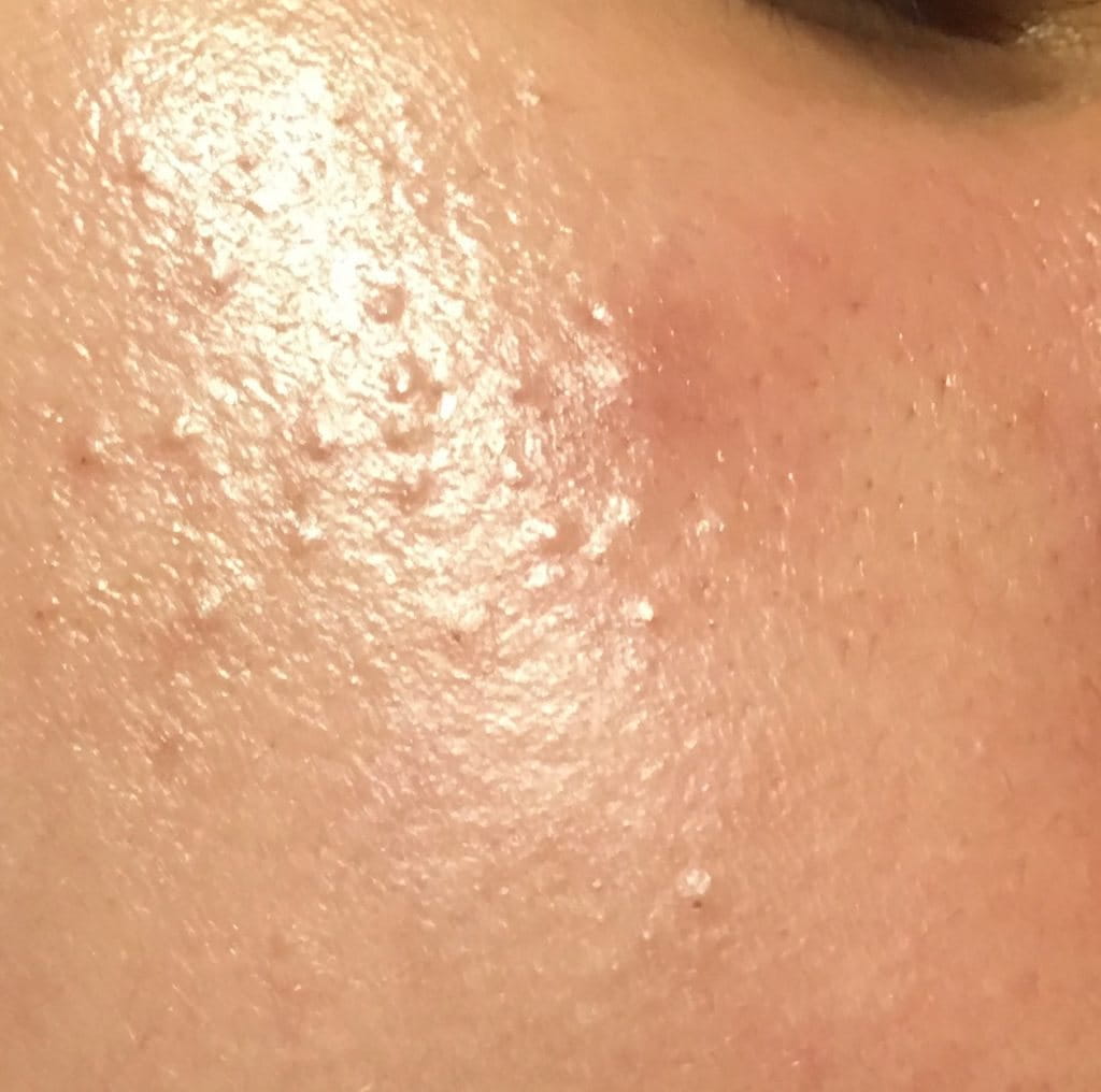 các bước skincare cho da mụn ẩn