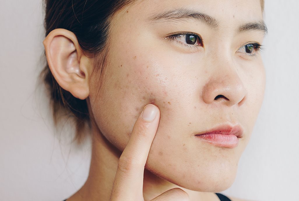 các bước skincare cho da mụn tuổi dậy thì