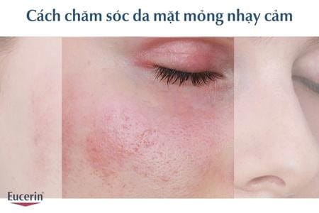 Cách chăm sóc da mặt mỏng nhạy cảm đúng chuẩn, hiệu quả