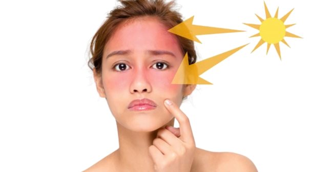 Làn da mùa nắng nóng gặp phải vô vàn các vấn đề đáng lo ngại