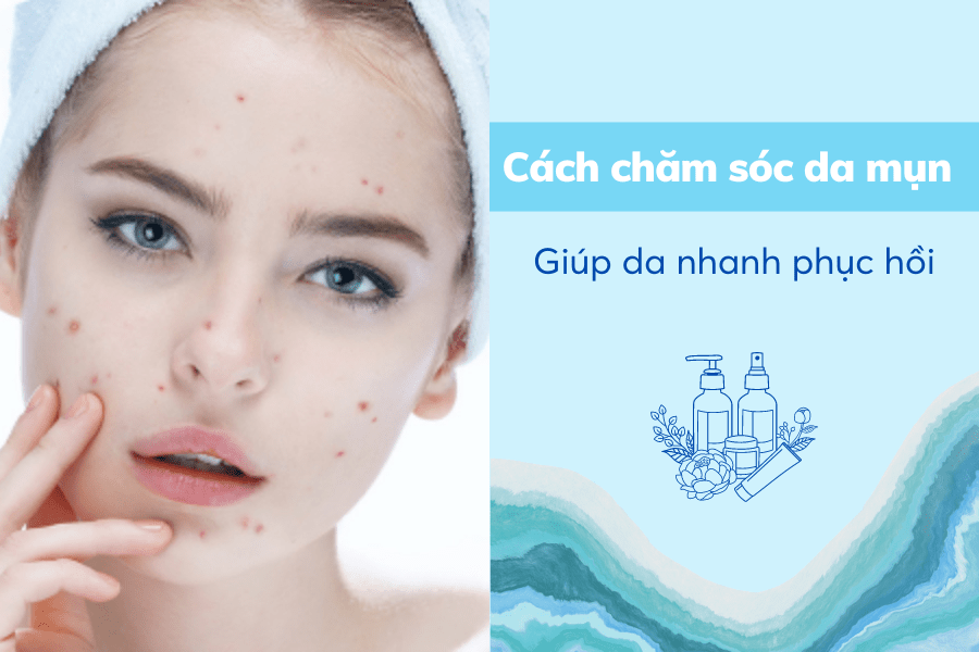 cách chăm sóc da mụn