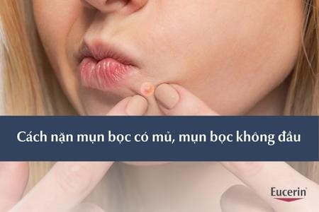 Cách nặn mụn bọc có mủ, mụn bọc không đầu