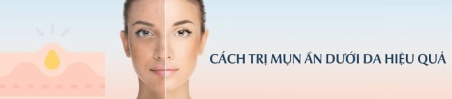 cách trị mụn ẩn dưới da